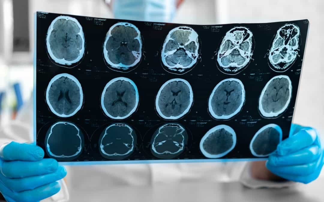 Maximize Compensation with a Florida Brain Injury Lawyer